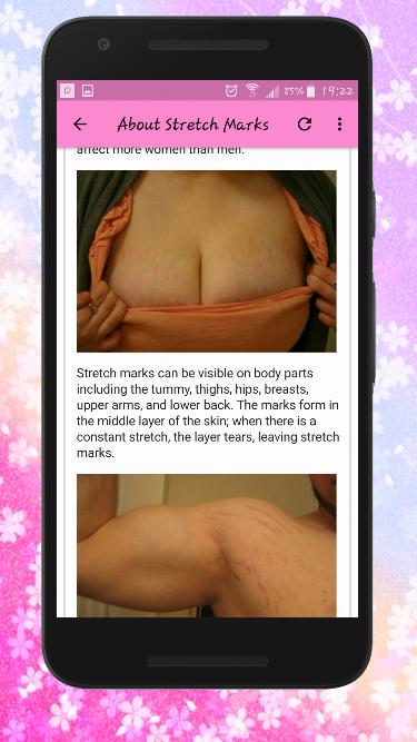 Get rid of STRETCH MARKS Natur